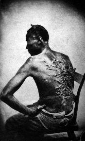 Photo documentary from the time of the American Civil War: Gordon, the Whipped Slave Shows His Scars (1863)